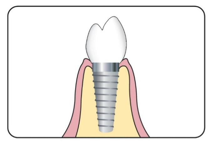 The Dental Implant Process – TePe Oral Health Care, Inc.