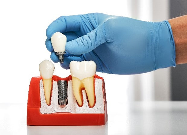 Are you a candidate for dental implants?